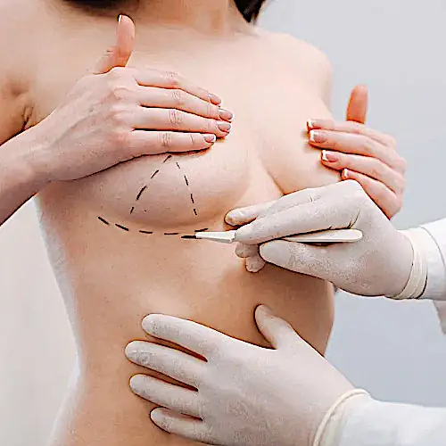 Профилактическая (превентивная) мастэктомия